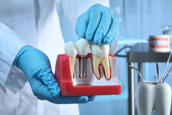 Dental Implant To Replace Single Missing Tooth